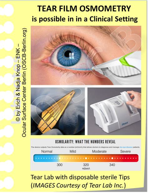 tear film evaluation tests|tear film interferometry.